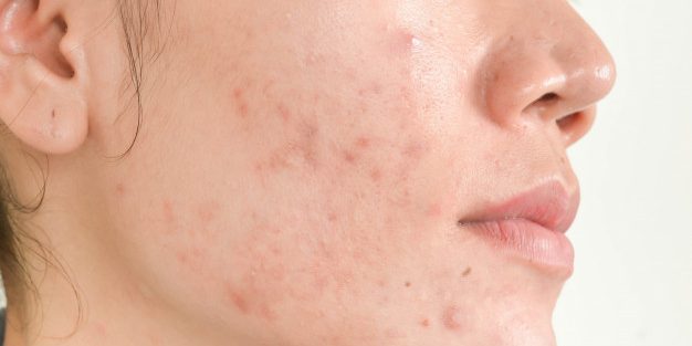 cicatriz-de-acne-no-rosto_46178-2